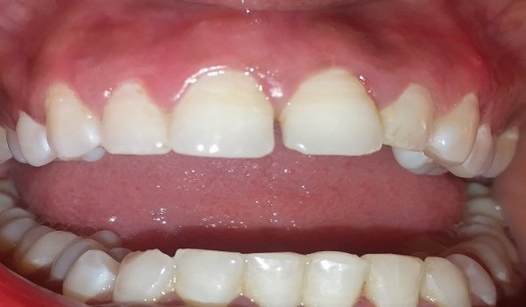 dental result after