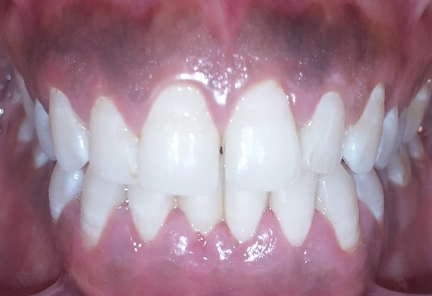 dental result before